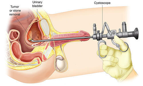 prostate laser surgery
