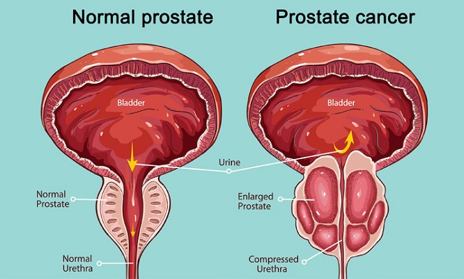 Prostate-Cancer