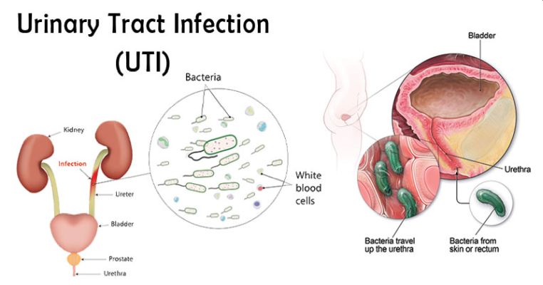 Urinary-Tract-Infection