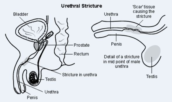 Urethral-Stricture