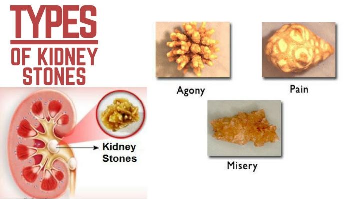 Kidney-Stone-Types